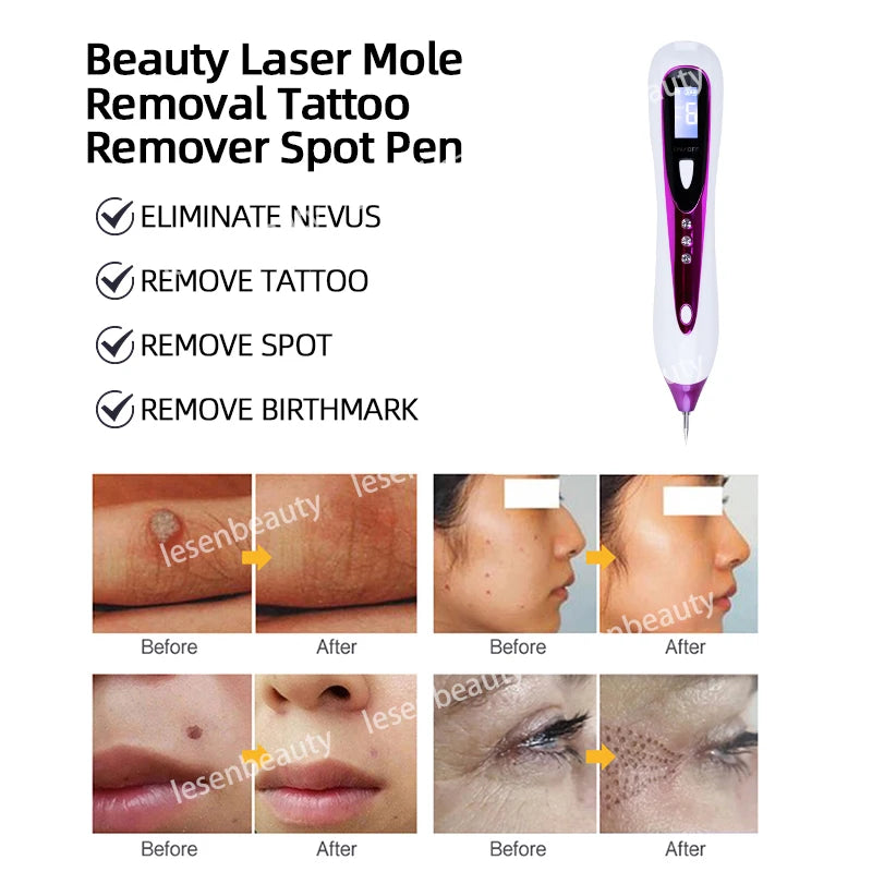 Precision Plasma Spot Remover